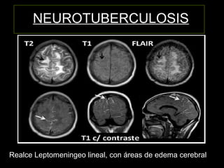 NEUROTUBERCULOSIS
Realce Leptomeningeo lineal, con áreas de edema cerebral
 