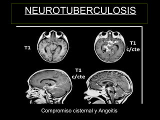 NEUROTUBERCULOSIS
Compromiso cisternal y Angeitis
 