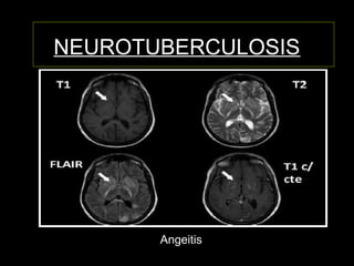 NEUROTUBERCULOSIS
Angeitis
 