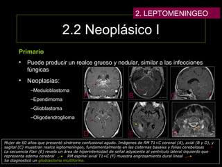 2.2 Neoplásico I
Primario
• Puede producir un realce grueso y nodular, similar a las infecciones
fúngicas
• Neoplasias:
–Meduloblastoma
–Ependimoma
–Glioblastoma
–Oligodendroglioma
Mujer de 60 años que presentó síndrome confusional agudo. Imágenes de RM T1+C coronal (A), axial (B y D), y
sagital (C) muestran realce leptomeníngeo, fundamentalmente en las cisternas basales y folias cerebelosas
La secuencia Flair (E) revela un área de hiperintensidad de señal adyacente al ventrículo lateral izquierdo que
representa edema cerebral RM espinal axial T1+C (F) muestra engrosamiento dural lineal
Se diagnosticó un glioblastoma multiforme.
CA B
D E F
2. LEPTOMENINGEO
 