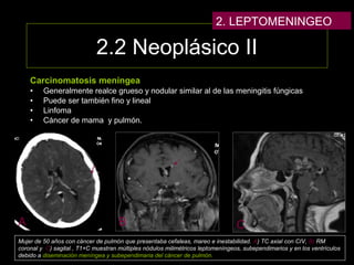 2.2 Neoplásico II
Carcinomatosis meníngea
• Generalmente realce grueso y nodular similar al de las meningitis fúngicas
• Puede ser también fino y lineal
• Linfoma
• Cáncer de mama y pulmón.
Mujer de 50 años con cáncer de pulmón que presentaba cefaleas, mareo e inestabilidad. A) TC axial con CIV, B) RM
coronal y C) sagital , T1+C muestran múltiples nódulos milimétricos leptomeníngeos, subependimarios y en los ventrículos
debido a diseminación meníngea y subependimaria del cáncer de pulmón.
A B C
2. LEPTOMENINGEO
 