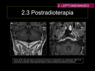 2.3 Postradioterapia
Varón de 66 años de edad con carcinoma de cavum en tratamiento con radioterapia. RM T1+C
coronal (A) y axial (B): realce leptomeníngeo en folias cerebelosas posteriores derechas
2. LEPTOMENINGEO
 