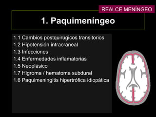 1.1 Cambios postquirúgicos transitorios
1.2 Hipotensión intracraneal
1.3 Infecciones
1.4 Enfermedades inflamatorias
1.5 Neoplásico
1.7 Higroma / hematoma subdural
1.6 Paquimeningitis hipertrófica idiopática
1. Paquimeníngeo
REALCE MENÍNGEO
 