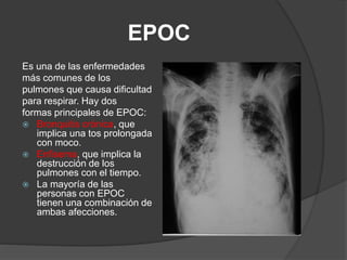 EPOC 
Valores normales 
 Presión parcial de oxígeno (PaO2): 75 - 100 mmHg 
 Presión parcial de dióxido de carbono (PaCO2...