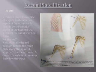 Principal of arthrodesis | PPTX