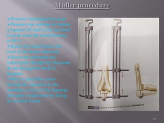 Principal of arthrodesis | PPTX