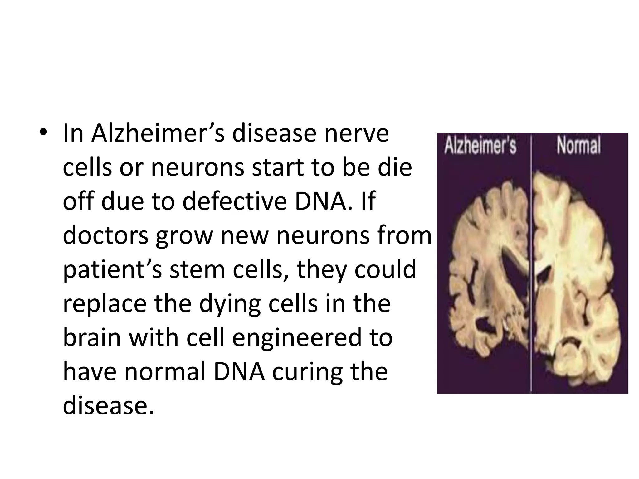 • In Alzheimer’s disease nerve
cells or neurons start to be die
off due to defective DNA. If
doctors grow new neurons from
patient’s stem cells, they could
replace the dying cells in the
brain with cell engineered to
have normal DNA curing the
disease.
 