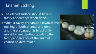 Enamel Etching
 The etched surface should have a
frosty appearance when dried.
 When a cavity preparation involves the
etching of both enamel and dentin
and the preparation is left slightly
moist for wet denting bonding, the
frosty appearance of the enamel
cannot be determined.
 