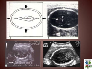 Grado2: Placa corionica con ondulaciones mas marcadas. Sustancia placentaria con mas ecogenicidades con forma de comas que se acercan a la placa basal pero no la alcanzan. Placa basal ecogenicidad lineal en el área subyacente