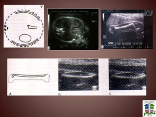 Grado3: Placa corial marcadamente ondulada.Sustancia placentaria las ecogenicidades van desde la placa corial hasta la placa basal y presenta areas anecoicas.Placa basal con líneas ecogenicas mayores que presentan sombra acústica.Grados placentarios: Nunca puede presentarse un grado 0 después de las 33 sem(retardo de la maduración) o un grado 3 antes de las 33 sem (presenta una aceleración en la maduración)