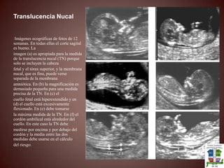 Cordón UmbilicalSe debe ver tres vasos dentro del cordón umbilical, la falta de alguno se puede asociar a trisomias. 