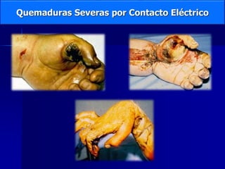 Quemaduras Severas por Contacto Eléctrico
 
