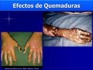 Efectos de Quemaduras
 