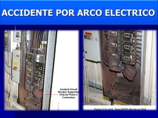 ACCIDENTE POR ARCO ELECTRICO
 