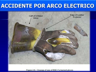 ACCIDENTE POR ARCO ELECTRICO
 