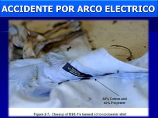 ACCIDENTE POR ARCO ELECTRICO
 