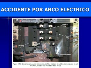 ACCIDENTE POR ARCO ELECTRICO
 