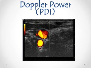 Doppler Power
   (PDI)
 