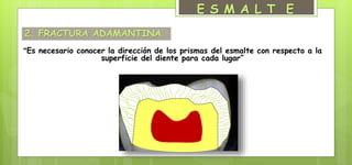 2. FRACTURA ADAMANTINA
“Es necesario conocer la dirección de los prismas del esmalte con respecto a la
superficie del diente para cada lugar”
E S M A L T E
 