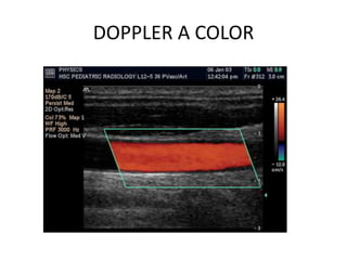 DOPPLER A COLOR
 