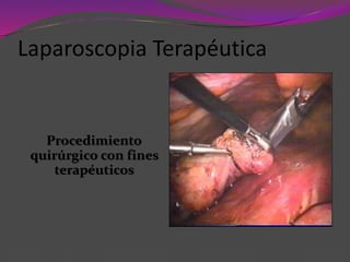 Procedimiento
quirúrgico con fines
terapéuticos
Laparoscopia Terapéutica
 
