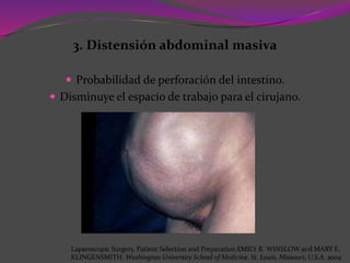 3. Distensión abdominal masiva
 Probabilidad de perforación del intestino.
 Disminuye el espacio de trabajo para el cirujano.
Laparoscopic Surgery. Patient Selection and Preparation.EMILY R. WINSLOW and MARY E.
KLINGENSMITH. Washington University School of Medicine. St. Louis, Missouri, U.S.A. 2009
 