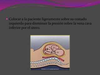  Colocar a la paciente ligeramente sobre su costado
izquierdo para disminuir la presión sobre la vena cava
inferior por el útero.
 