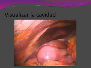 Visualizar la cavidad
 
