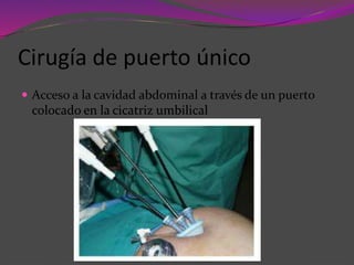 Cirugía de puerto único
 Acceso a la cavidad abdominal a través de un puerto
colocado en la cicatriz umbilical
 
