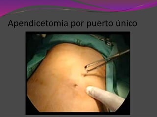 Apendicetomía por puerto único
 