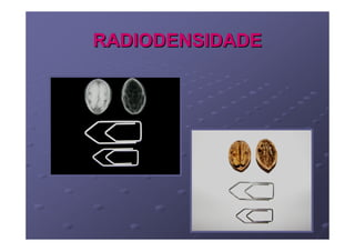 RADIODENSIDADE
 