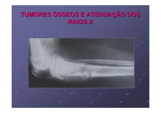 TUMORES ÓSSEOS E ATENUAÇÃO DOS
            RAIOS X
 