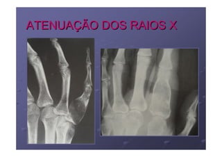 ATENUAÇÃO DOS RAIOS X
 