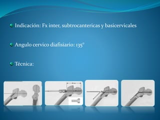Indicaciones: Fx subtrocantericas y fx 1/3 distal de
fémur (supra, inter y unicondilea).
Condiciones anatómicas: la porció...