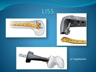 Proximal Tibia Locking Compression Plate
The indications for this 4.5mm plate system are for proximal tibia fractures incl...