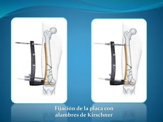 Humerus Block
The Humerus Block is indicated for the
treatment of subcapital and intraarticular
proximal humeral fractures...