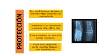 PROTECCIÓN
Es el uso de implantes agregados a
una osteosíntesis y que actúan de
manera distinta
Complementar una osteosíntesis
insuficiente para evitar su falla
Trazos susceptibles de compresión
que sea insuficiente.
Placas rectas y especiales,
clavillos, tornillos, fIjadores y
clavos endomedulares.
 