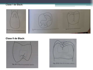 Clase I de Black:

Clase II de Black:

 