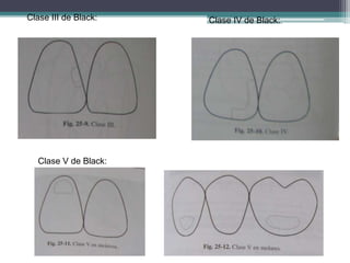 Clase III de Black:

Clase V de Black:

Clase IV de Black:

 
