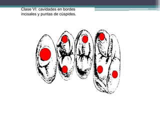Clase VI: cavidades en bordes
incisales y puntas de cúspides.

 