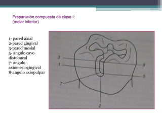 Preparación compuesta de clase I:
(molar inferior)

1- pared axial
2-pared gingival
3-pared mesial
5- angulo cavo
distobucal
7- angulo
axiomesiogingival
8-angulo axiopulpar

 