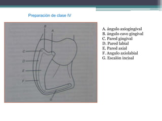 Preparación de clase IV
A. ángulo axiogingival
B. ángulo cavo gingival
C. Pared gingival
D. Pared labial
E. Pared axial
F. Angulo axiolabial
G. Escalón incisal

 