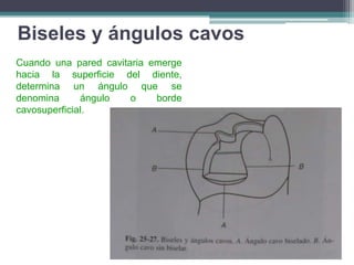 Biseles y ángulos cavos
Cuando una pared cavitaria emerge
hacia la superficie del diente,
determina un ángulo que se
denomina
ángulo
o
borde
cavosuperficial.

 