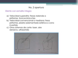 No. 2 apertura
Diente con esmalte integro:
a) Velocidad superalta: fresas redonda o
piriforme, troncocónica lisa
b) Velocidad convencional o mediana: fresa
piriforme, piedra adamantada esférica o cono
invertido
c) Otros sistemas de corte: laser, aire
abrasivo, ultrasonido

 