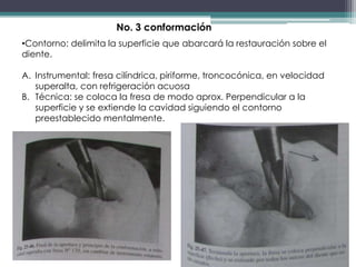 No. 3 conformación
•Contorno: delimita la superficie que abarcará la restauración sobre el
diente.
A. Instrumental: fresa cilíndrica, piriforme, troncocónica, en velocidad
superalta, con refrigeración acuosa
B. Técnica: se coloca la fresa de modo aprox. Perpendicular a la
superficie y se extiende la cavidad siguiendo el contorno
preestablecido mentalmente.

 