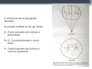 4. Influencia de la topografía
dentaria:

Se puede analizar en las sig. áreas:
A. Caras oclusales de molares y
premolares
B y C. Caras proximales y caras
libres
D. Caras linguales de incisivos y
caninos superiores

 