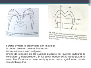 4. Debe evitarse la proximidad con la pulpa:
Se deben tener en cuenta 2 aspectos:
-Zona peripulpar: área peligrosa.
-Líneas de recesión de los cuernos pulpares: los cuernos pulpares se
mineralizan y desaparecen. En las zonas donde existía tejido pulpar la
mineralización a veces no es total y quedan restos orgánicos en donde
antes había pulpa.

 