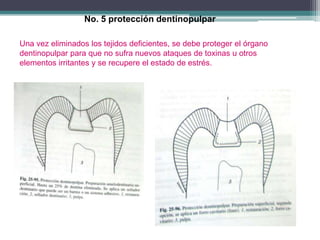 No. 5 protección dentinopulpar
Una vez eliminados los tejidos deficientes, se debe proteger el órgano
dentinopulpar para que no sufra nuevos ataques de toxinas u otros
elementos irritantes y se recupere el estado de estrés.

 