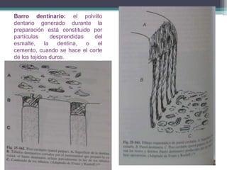 Barro dentinario: el polvillo
dentario generado durante la
preparación está constituido por
partículas
desprendidas
del
esmalte,
la
dentina,
o
el
cemento, cuando se hace el corte
de los tejidos duros.

 