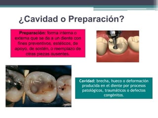 ¿Cavidad o Preparación?
Preparación: forma interna o
externa que se da a un diente con
fines preventivos, estéticos, de
apoyo, de sostén, o reemplazo de
otras piezas ausentes.

Cavidad: brecha, hueco o deformación
producida en el diente por procesos
patológicos, traumáticos o defectos
congénitos.

 